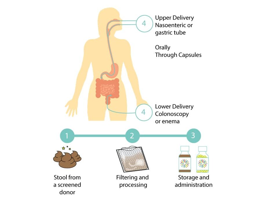 Fecal Microbiota Transplantation The Pharmacologist